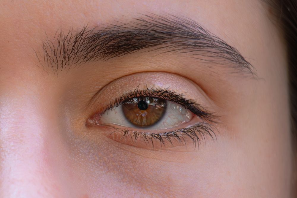 a girl have a disease name is Black sclera